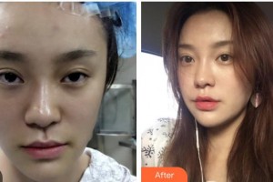 四川西嬋泛亞醫(yī)學美容醫(yī)院賴穎整形價格表附埋線提升案例展示