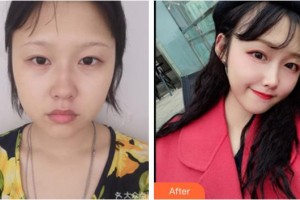 四川西嬋泛亞醫(yī)學美容醫(yī)院張蕾整形價格表附埋線提升案例展示