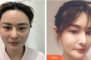 四川西嬋泛亞醫(yī)學美容醫(yī)院程林整形價格表附埋線提升案例展示