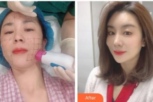 自貢華西友好醫(yī)院整形美容科崔熙允整形價格表附熱瑪吉案例展示