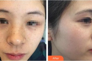 自貢均閣醫(yī)學美容連鎖謝仕喬整形價格表附光子嫩膚案例展示