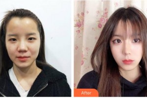 自貢尚美整形醫(yī)院鐘曉明整形價格表附膨體隆鼻案例展示