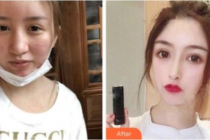 自貢市第四人民醫(yī)院整形美容科鐘俊波整形價格表附肋軟骨隆鼻案例展示