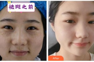 自貢市第四人民醫(yī)院整形美容科朱必清整形價格表附激光祛斑案例展示