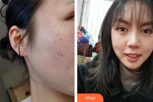 自貢市第四人民醫(yī)院整形美容科曾妮整形價格表附光子嫩膚案例展示