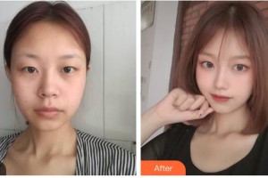 自貢市第四人民醫(yī)院整形美容科鐘富彬住院醫(yī)師整形價格表附光子嫩膚案例展示