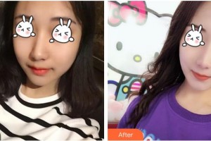 自貢市第四人民醫(yī)院整形美容科何建霖住院醫(yī)師整形價格表附光子嫩膚案例展示