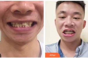 自貢維樂新橋口腔門診部米蓉整形價格表附牙齒隱形矯正案例展示