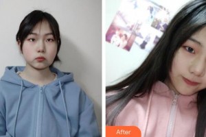 攀枝花市中心醫(yī)院燒傷整形美容科汪濤整形價格表附埋線提升案例展示