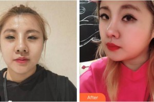 攀枝花市中心醫(yī)院燒傷整形美容科張蕊整形價格表附熱瑪吉案例展示