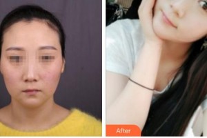 攀枝花中韓卓美博大醫(yī)院醫(yī)療美容科楊洪英整形價格表附埋線提升案例展示