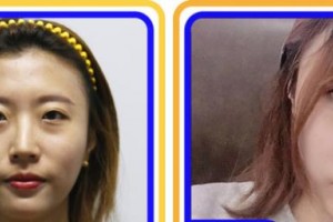 攀枝花愛爾眼科醫(yī)院江蓉整形價格表附眼部綜合案例展示