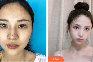 瀘州華藝整形美容診所羅吉華整形價格表附下瞼整形案例展示