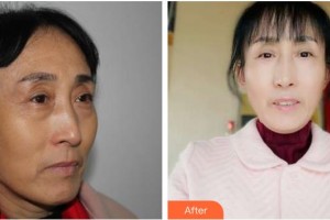 瀘州碧特牙科醫(yī)院屈晶整形價格表附外切祛眼袋案例展示