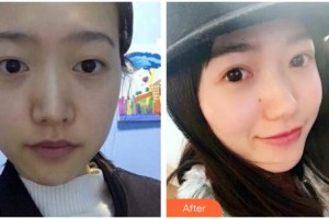 瀘州醫(yī)學院附屬醫(yī)院整形燒傷科廖毅 教授整形價格表附切開雙眼皮案例展示