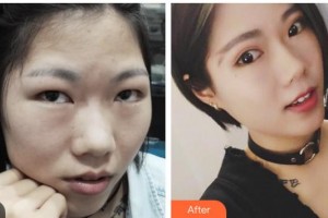 瀘州醫(yī)學院附屬醫(yī)院整形燒傷科熊愛兵整形價格表附切開雙眼皮案例展示