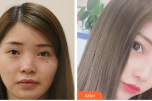 瀘州醫(yī)學(xué)院附屬醫(yī)院整形燒傷科何小川整形價格表附鼻部綜合例展示