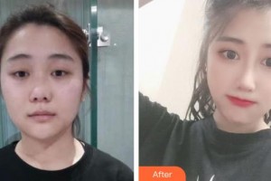 瀘州醫(yī)學(xué)院附屬醫(yī)院整形燒傷科李越鋼整形價格表附肋軟骨隆鼻案例展示