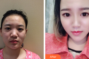 深圳美客華美醫(yī)療美容門診部王力佳整形價格表附清潔祛痘案例展示