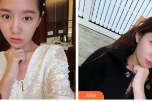 瀘州愛瑞眼科醫(yī)院梅芳整形價格表附切開雙眼皮案例展示