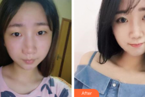 深圳瑞光醫(yī)療美容門診部周曉毛整形價(jià)格表附自然雙眼皮案例展示