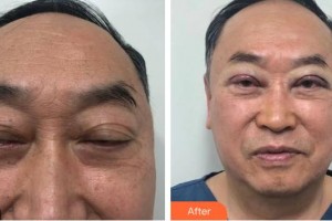 瀘州市婦幼保健院眼科曹世華整形價格表附眼部綜合案例展示