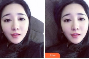 瀘州市婦幼保健院眼科羅光輝整形價格表附上眼瞼去脂案例展示