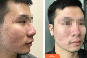 深圳博愛醫(yī)院整形美容中心楊昕整形價(jià)格表附清潔祛痘案例展示