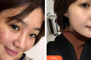 深圳軍科整形美容醫(yī)院劉金鳳整形價(jià)格表附痘坑痘印改良案例展示