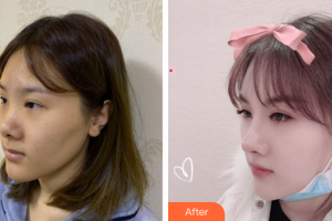 深圳微姿醫(yī)療美容門診部康壯為整形價(jià)格表附肋軟骨鼻部手術(shù)案例展示