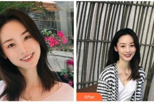 瀘州碧特牙科醫(yī)院雷光揚整形價格表附金屬托槽矯正案例展示