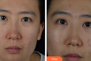 深圳廣濟(jì)門診部醫(yī)療美容科周鵬武整形價(jià)格表附去痘印痘坑案例展示