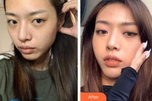 德陽東美醫(yī)療美容整形門診部李黠整形價格表附埋線提升案例展示