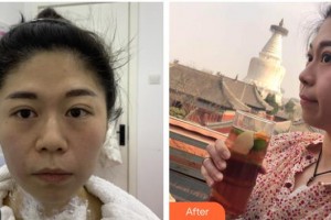 德陽德美醫(yī)療美容門診部莊景菊整形價格表附熱瑪吉案例展示