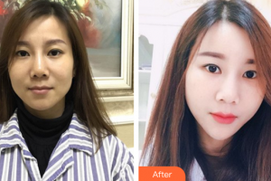 深圳東港醫(yī)療美容門診部艾志剛整形價(jià)格表附自體脂肪填充案例展示