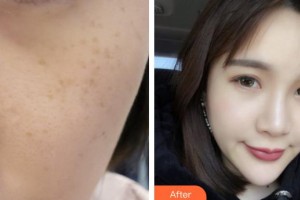 德陽德美醫(yī)療美容門診部張涖整形價格表附激光美膚激光案例展示