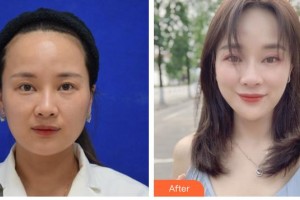 德陽市人民醫(yī)院燒傷整形科胡曉東整形價格表附埋線提升案例展示