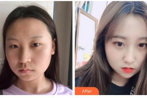 德陽市人民醫(yī)院燒傷整形科李永忠整形價格表附埋線提升案例展示