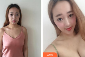 深圳和協(xié)門診部整形美容科李寶武整形價(jià)格表附假體豐胸案例展示