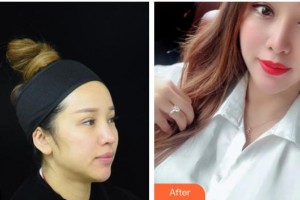 德陽市人民醫(yī)院燒傷整形科陸蓉整形價格表附射頻緊膚案例展示