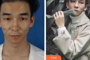 深圳和協(xié)門診部整形美容科安超整形價(jià)格表附祛痘煥膚案例展示