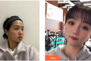 德陽金榮醫(yī)療美容?？漆t(yī)院吳沙冰整形價格表附埋線提升案例展示