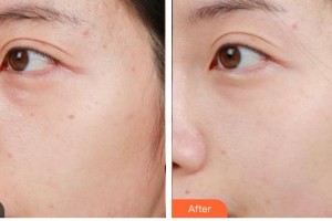 德陽金榮醫(yī)療美容專科醫(yī)院尹靜整形價格表附激光美膚激光案例展示