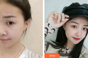 深圳和協(xié)門診部整形美容科牟北平整形價(jià)格表附眼部整形案例展示