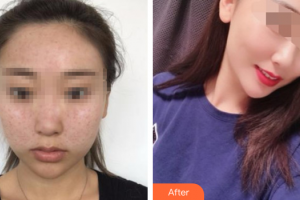 深圳和協(xié)門診部整形美容科劉開(kāi)山整形價(jià)格表附去痘印痘坑案例展示