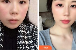 德陽(yáng)金榮醫(yī)療美容?？漆t(yī)院邊森整形價(jià)格表附鼻部綜合案例展示