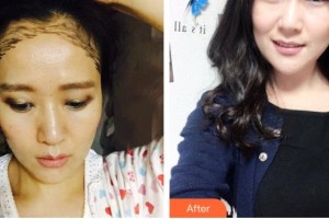 德陽(yáng)德美醫(yī)療美容門(mén)診部于洲戡整形價(jià)格表附種植發(fā)際線案例展示