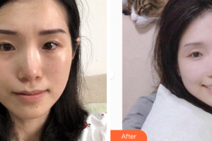 深圳鵬愛(ài)秀琪醫(yī)療美容醫(yī)院劉亞慧整形價(jià)格表附白瓷娃娃案例展示