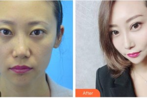 德陽(yáng)德美醫(yī)療美容門(mén)診部張莉整形價(jià)格表附埋線提升案例展示