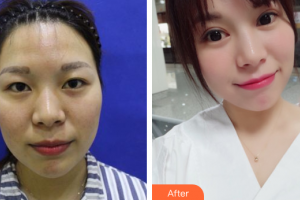 深圳鵬愛(ài)秀琪醫(yī)療美容醫(yī)院薛林兵整形價(jià)格表附全切雙眼皮案例展示